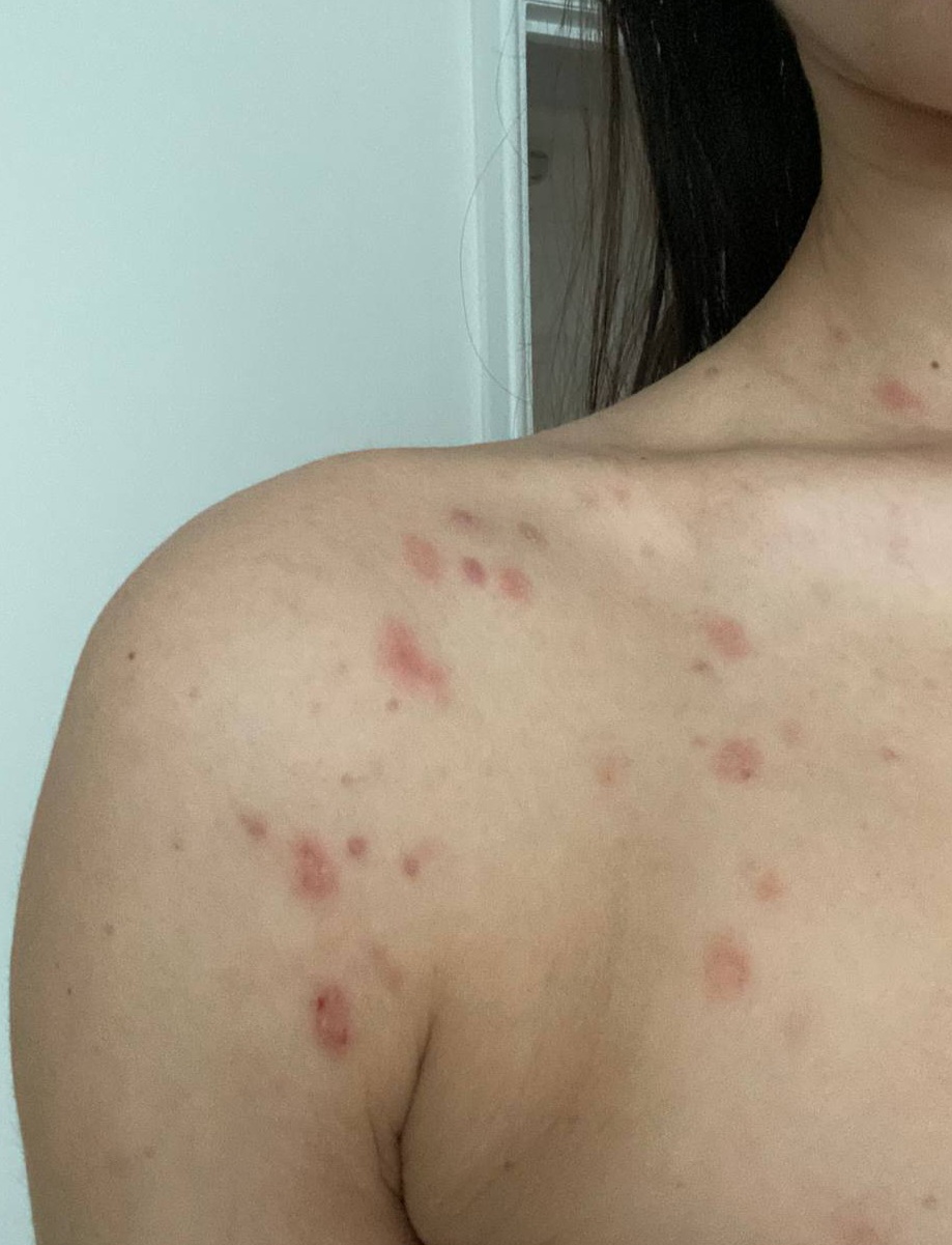 Victoria during her psoriasis journey — second unretouched photograph of her skin
